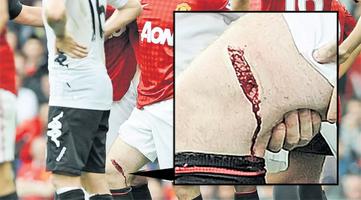 Wayne Rooney, atacantul lui Manchester United, a suferit o accidentare oribilă şi va lipsi o lună