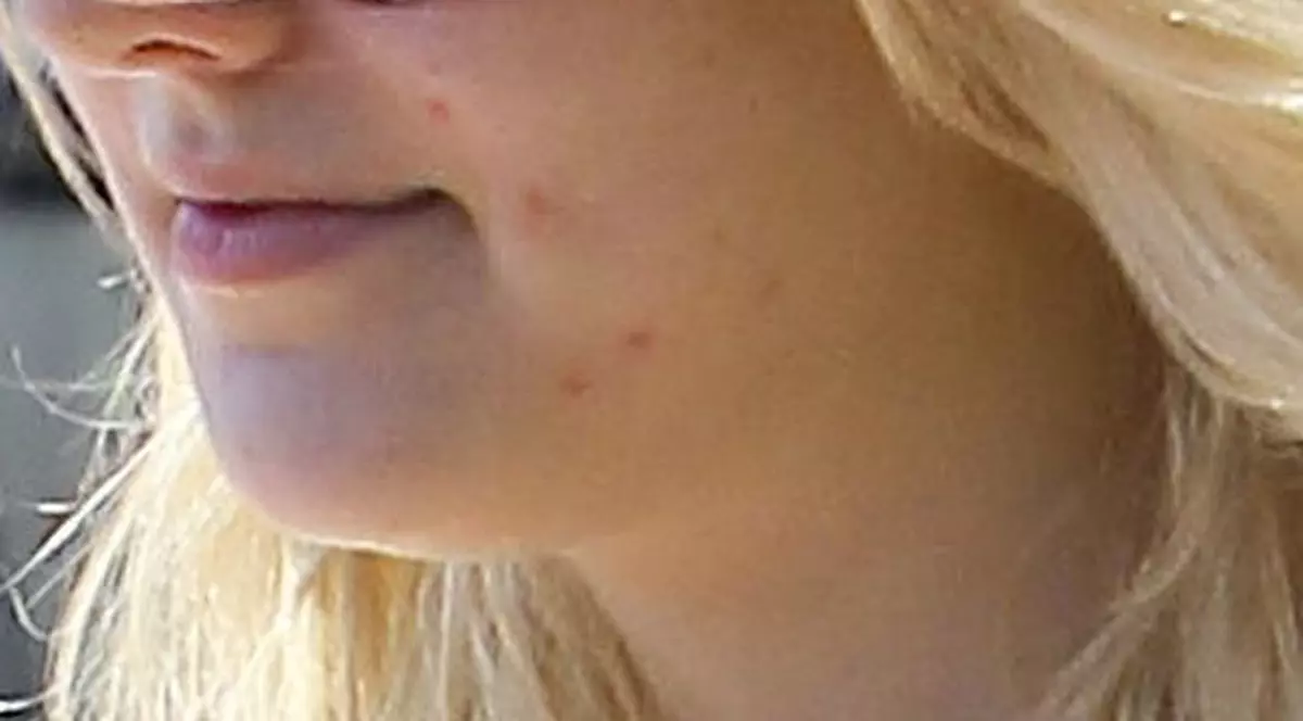 Actriță celebră, desfigurată de acnee| FOTO