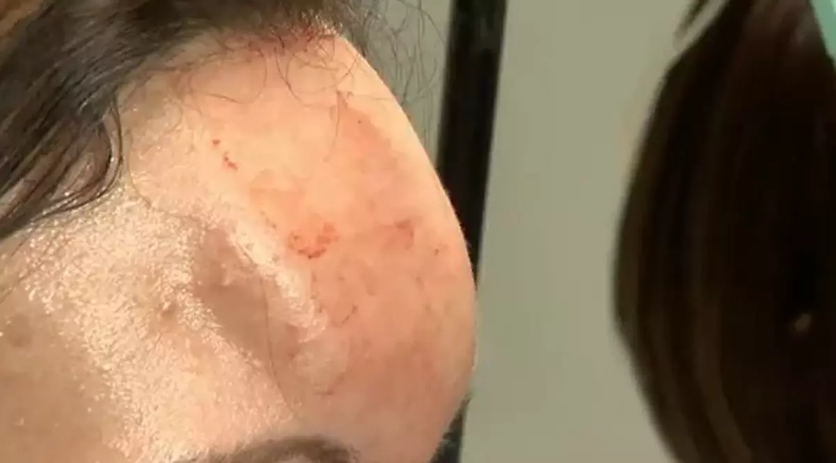 ATENŢIE, IMAGINI ŞOCANTE! Cum îşi mutilează tinerii frunţile, pentru a fi la modă