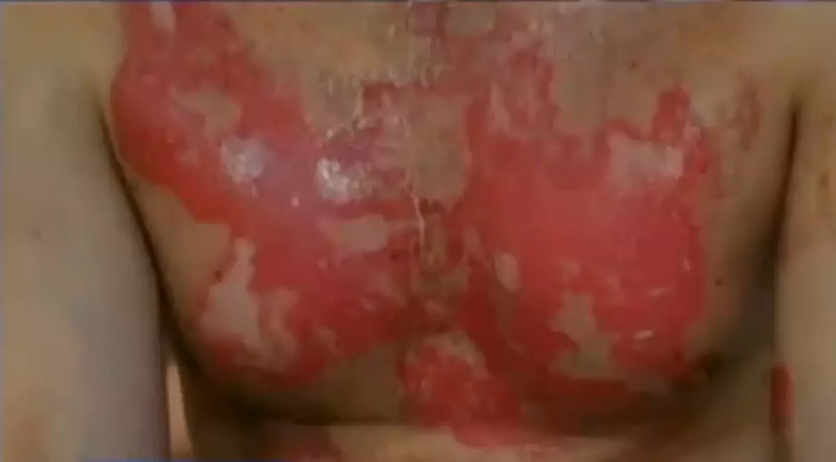 ŞOCANT! Poţi lua foc, încercând să te aperi de cancer!