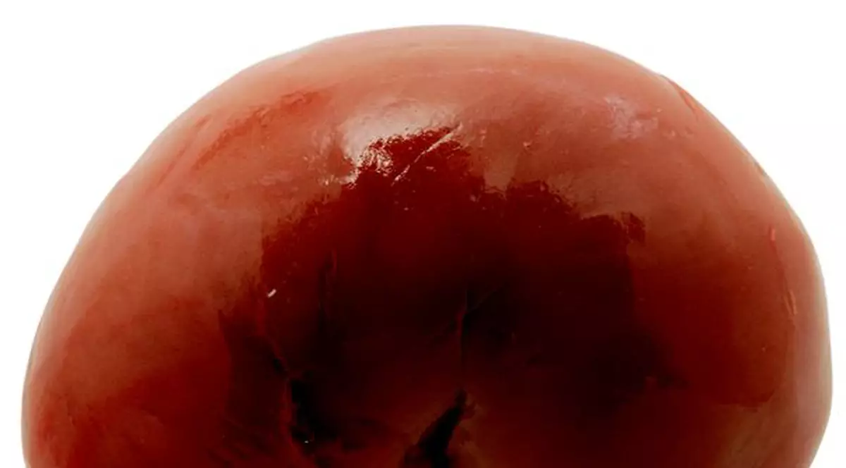 A murit omul care a realizat PRIMUL TRANSPLANT de RINICHI din LUME