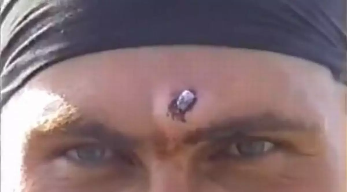 Terminator e mic copil! Cum reacționează un soldat rus în timp ce i se extrage un glonț din frunte, cu un patent - VIDEO