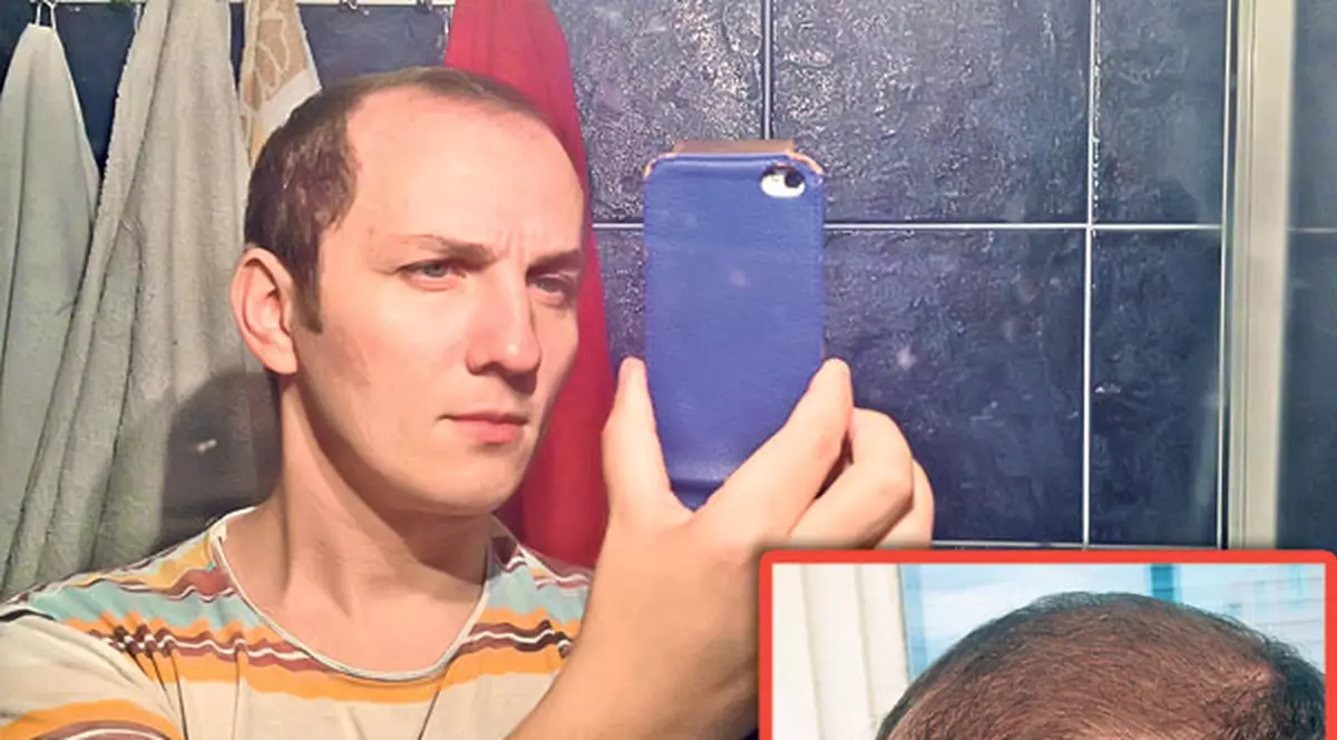 Trăistariu îşi măsoară zilnic părul! Cel mai lung fir măsoară deja o jumătate de centimetru