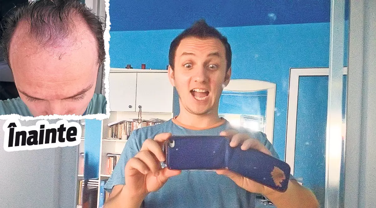 Mihai Trăistariu îl ia peste picior pe Răzvan Ciobanu, pe motiv că implantul acestuia n-a dat roade, ca în cazul lui: «Unde şi-a pus păr, că nu se vede?»