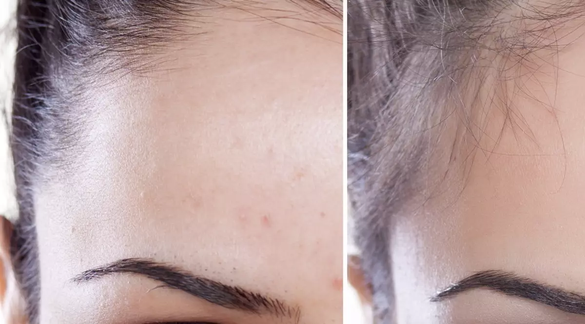 Cea mai simplă metodă să previi coșurile