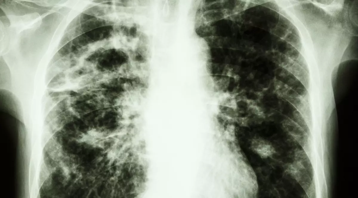 cele mai multe cazuri noi de tuberculoză înregistrate