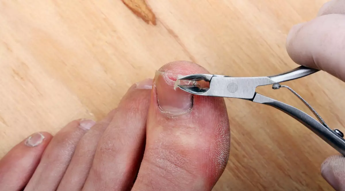 Cum tratezi corect o unghie infectată