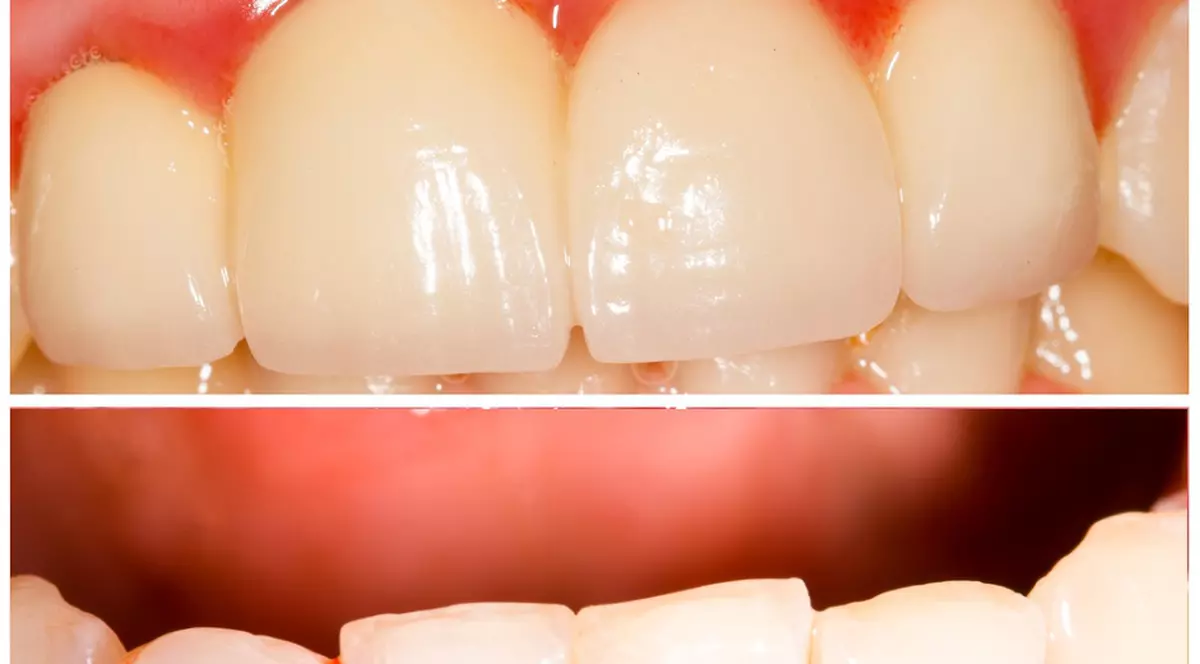Cum știi că suferi de boli ale gingiilor