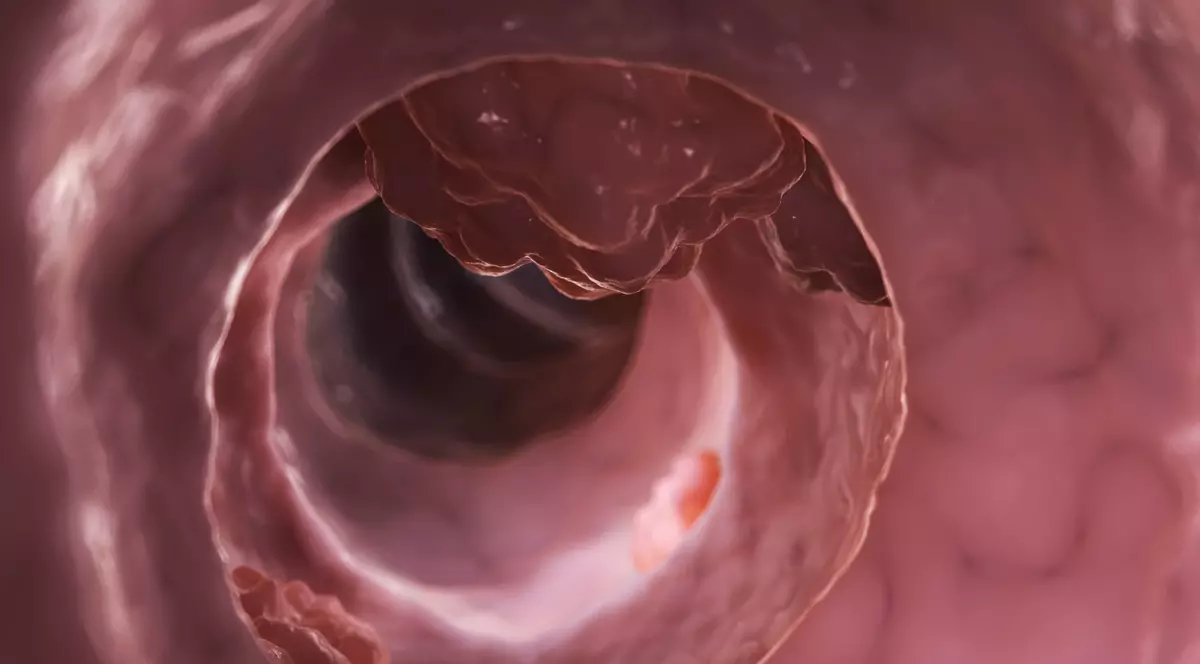 Top 4 factori de risc pentru apariția cancerului gastric