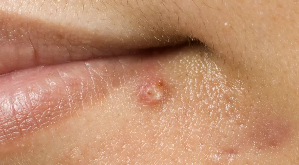Prea mult par = Hirsutism