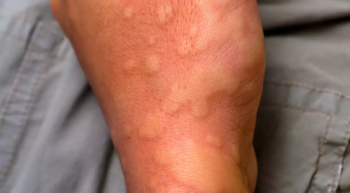 Alergiile cutanate si urticaria