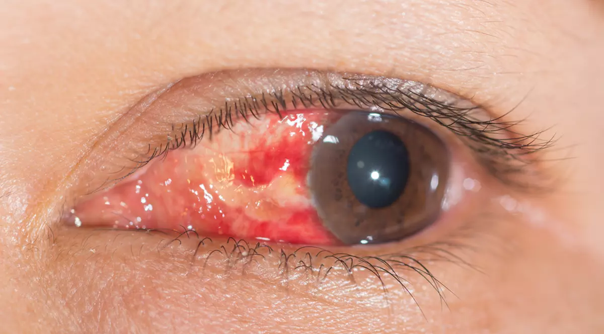 Ce spun ochii despre sănătatea ta