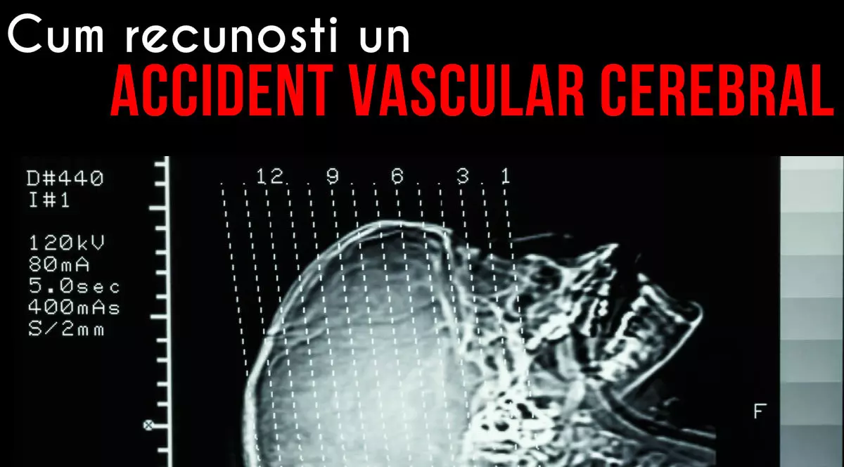 Accidentul vascular cerebral