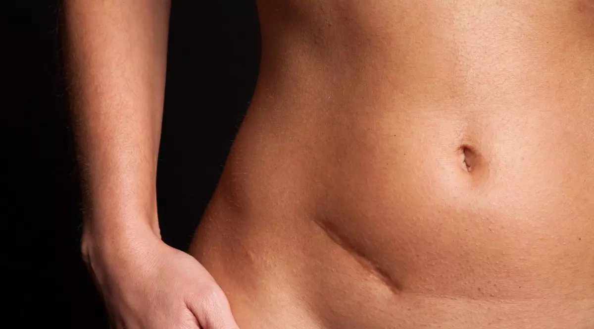 Ce se întâmplă dacă ţi se rupe un chist ovarian