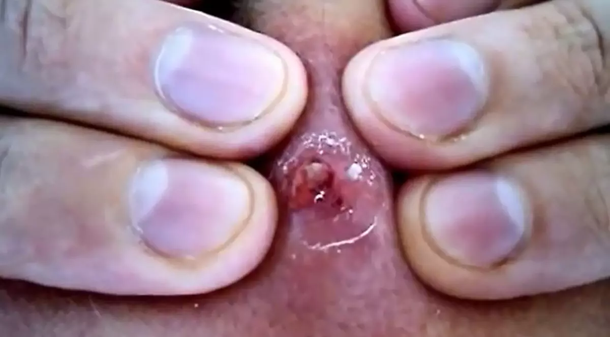 Momentul şocant în care un bărbat s-a hotărât să stoarcă un coş care îl chinuia de 20 de ani | VIDEO