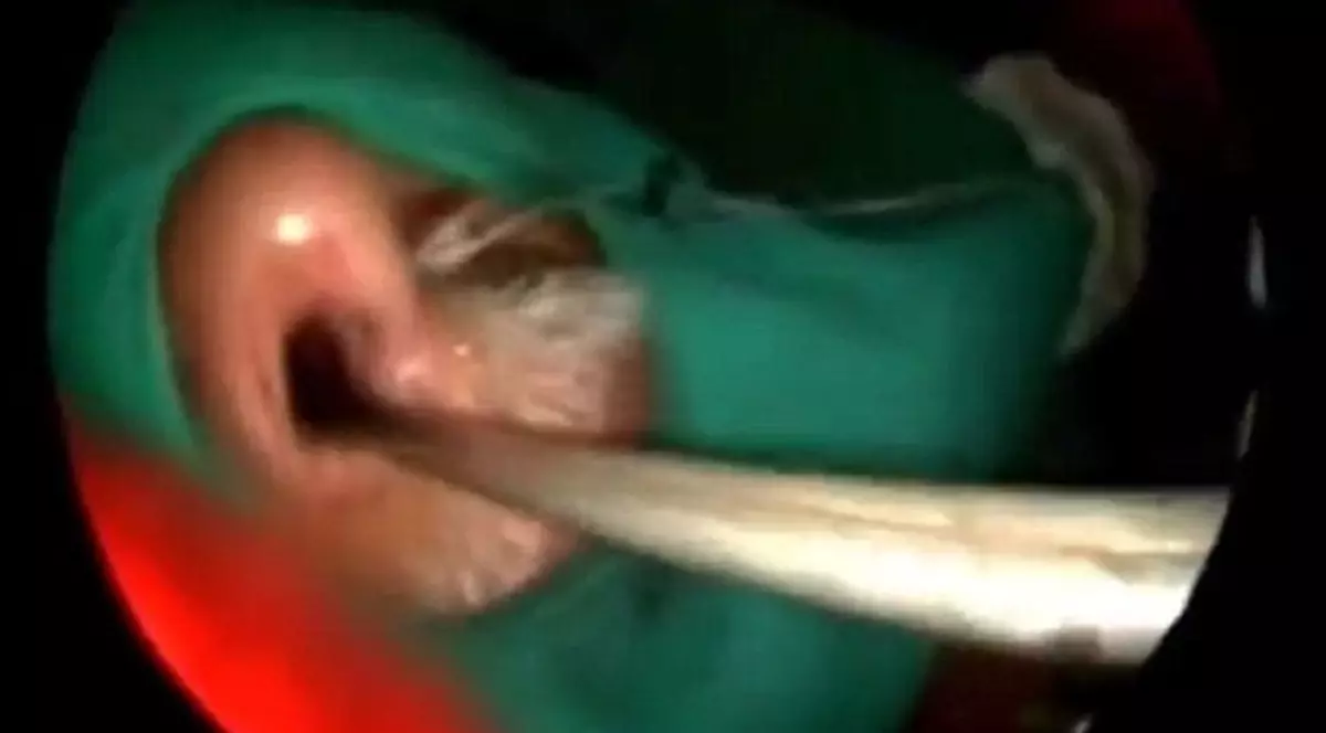 IMAGINI SCÂRBOASE! MEDICII i-au SCOS VIERMII din NAS unui BĂRBAT. Puteau SĂ-I MĂNÂNCE OCHII | VIDEO