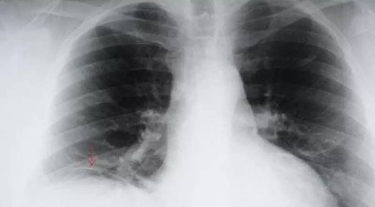 Fumatul ne vine de hac. Câţi români mor anual din cauza cancerului pulmonar?