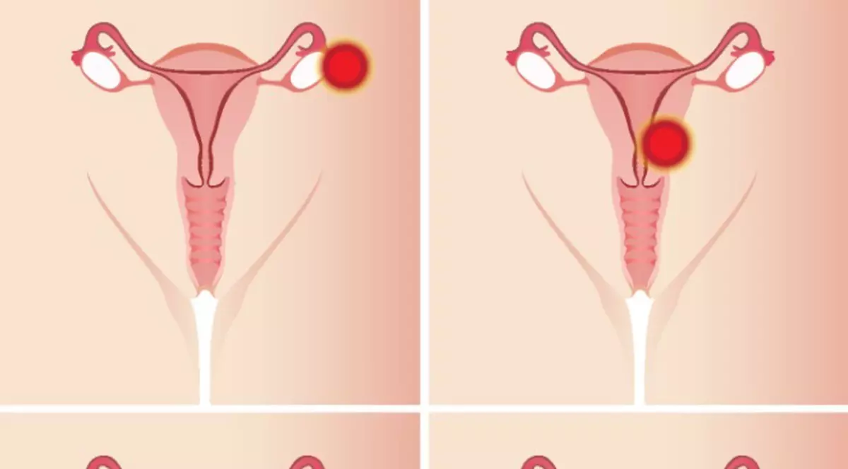 EFECTELE CAFELEI ASUPRA CICLULUI MENSTRUAL