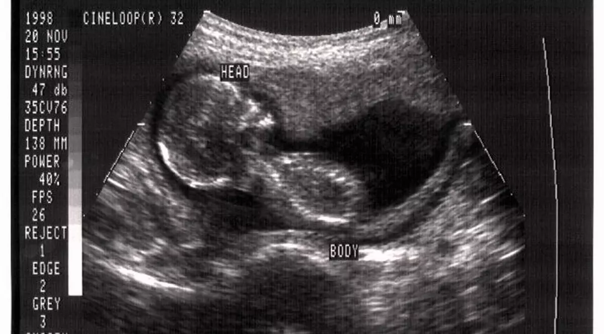 Recorduri despre sarcini și bebeluși. Cât a avut cel mai mare bebeluș la naștere, cel mai mic sau cât a durat cea mai lungă sarcină