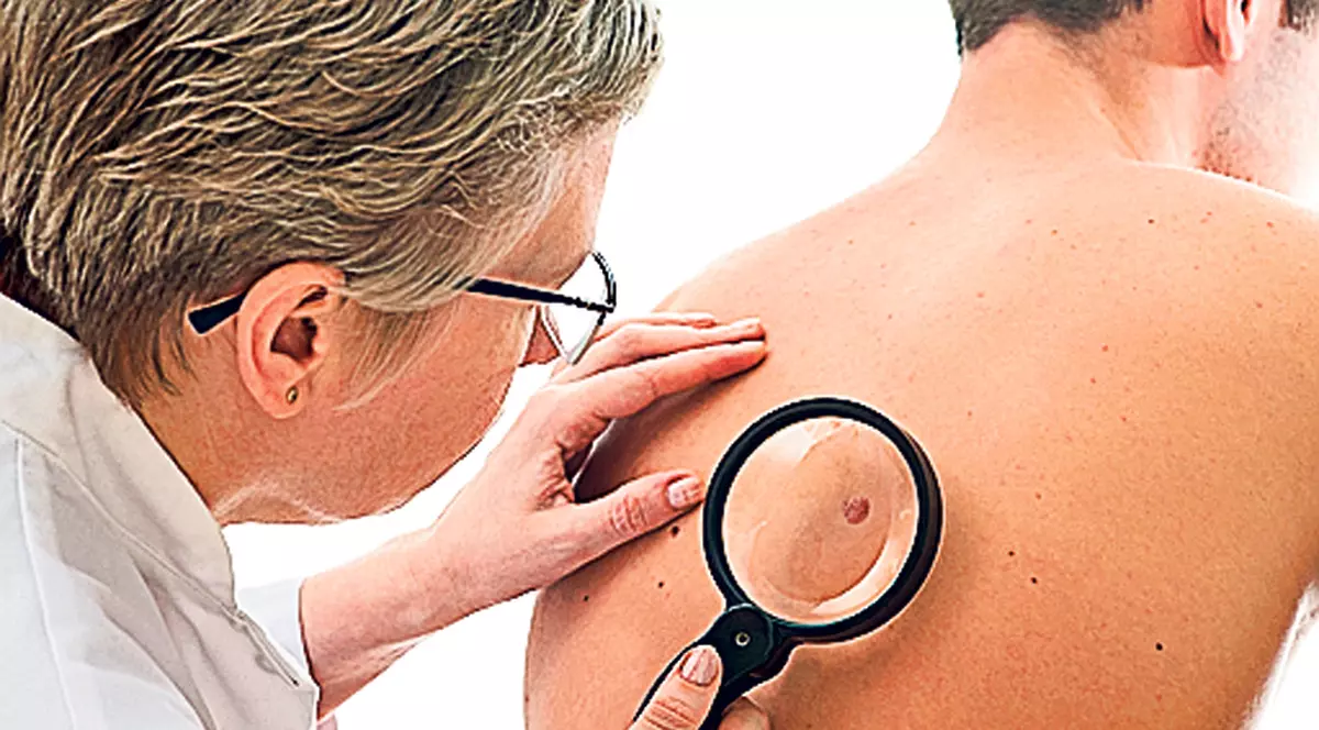 Un nou tratament contra cancerului de piele, în teste