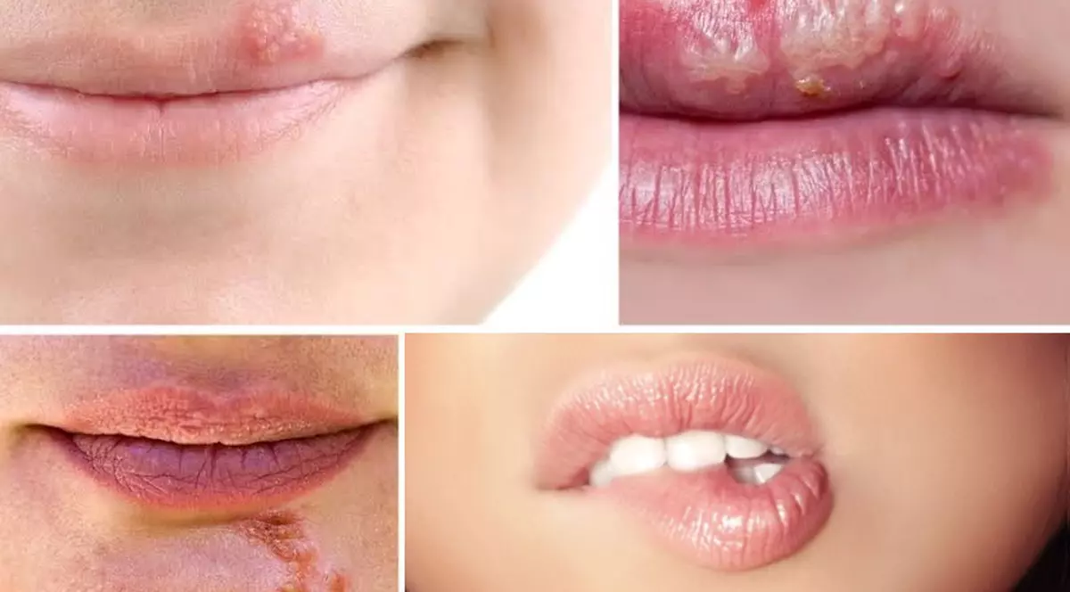 Cum îţi dai seama dacă ai herpes sau zona zoster