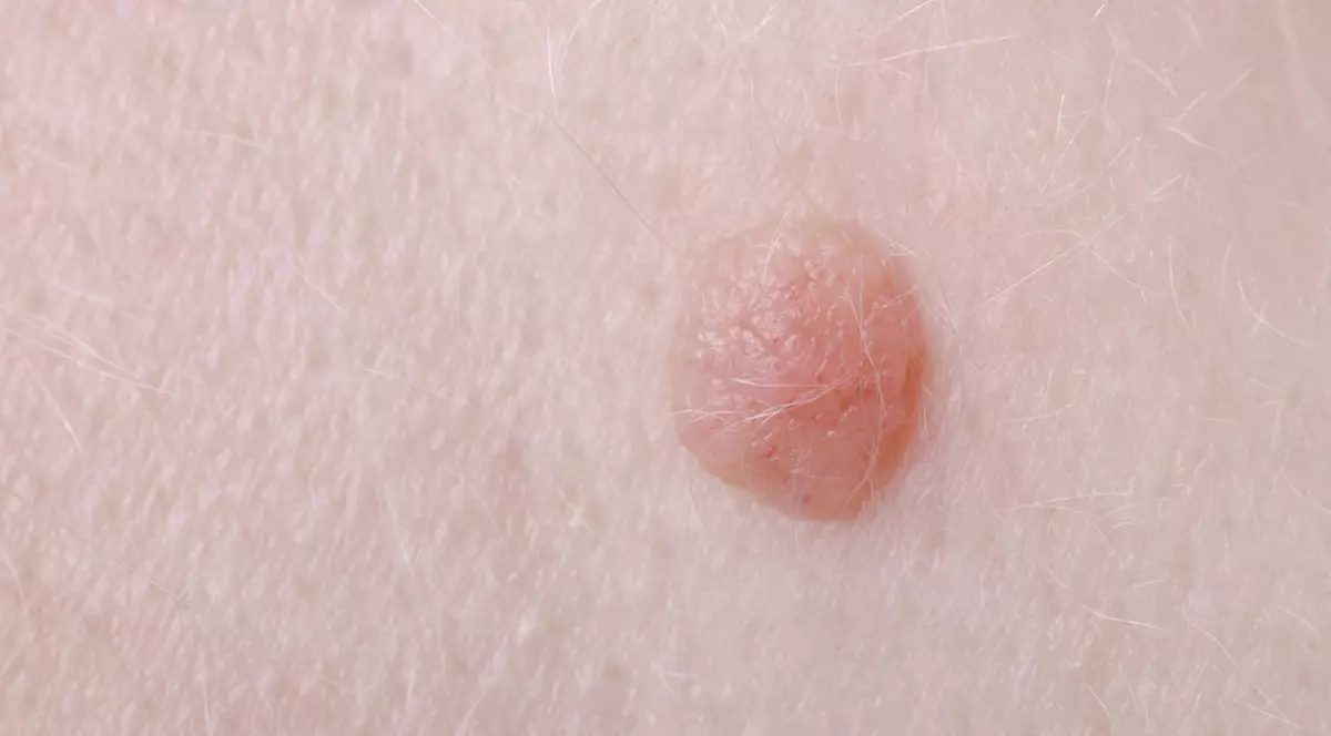Cum știi că ai luat virusul HPV