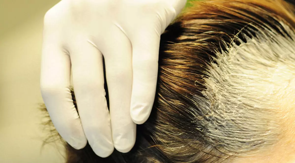 O studentă din Iaşi a ajuns de urgenţă la spital, după ce şi-a vopsit părul