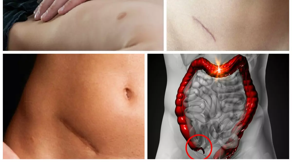 Te doare în partea dreaptă? Află dacă ai apendicită sau nu!