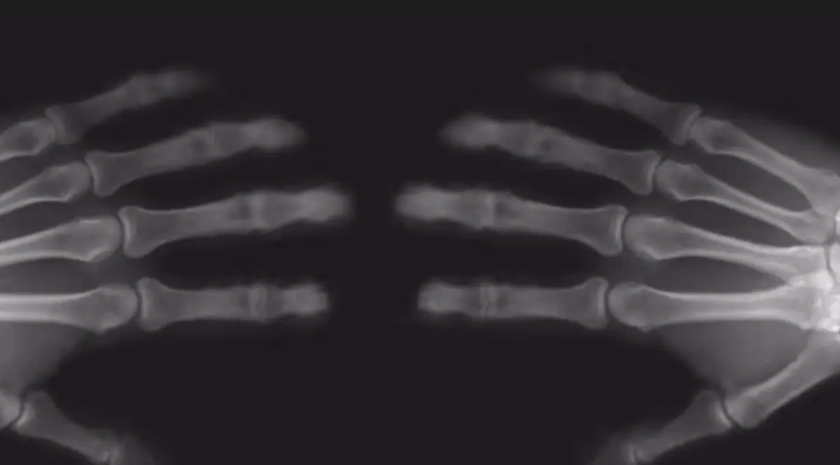 Îți trosnești des degetele? Ce pățesc de fapt articulațiile tale! VIDEO