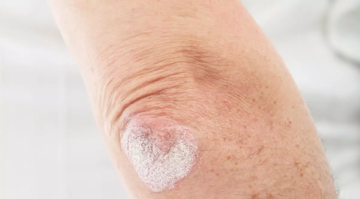 Psoriazisul - cum arată şi cum se tratează