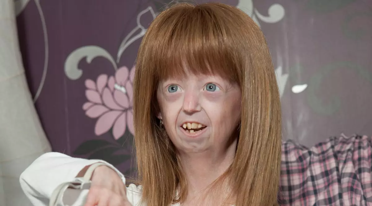 Adolescenta de 17 ani, captivă într-un trup de 100 de ani, a murit