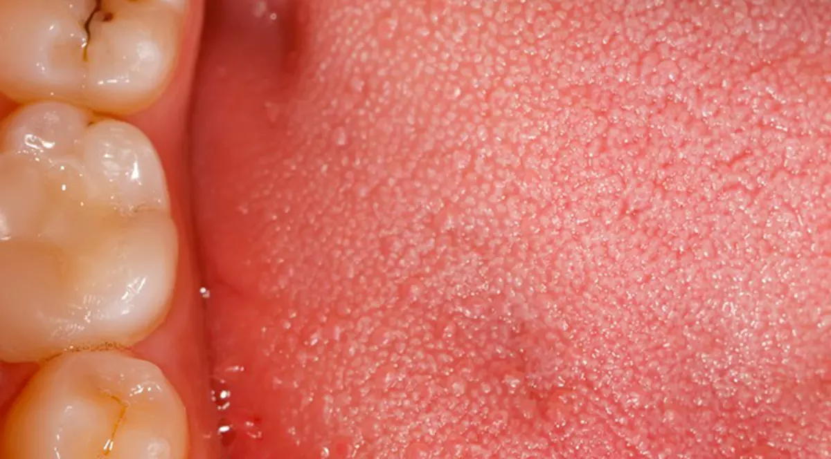 Ce poţi păţi dacă nu tratezi cariile