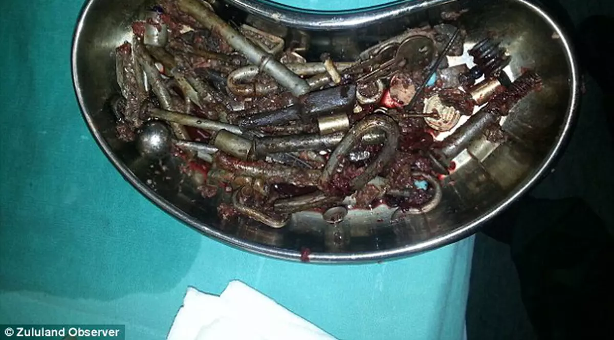 INCREDIBIL! Ce au găsit medicii în stomacul unui bărbat! N-ai fi crezut că e posibil așa ceva!