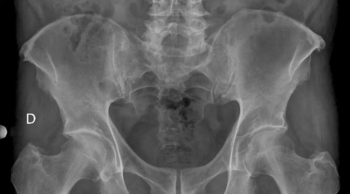 Un BĂTRÂNEL de 94 de ani s-a dus la spital cu DURERI CRUNTE de burtă. Medicii, uimiţi de ce avea în abdomen. Era acolo de 70 de ani