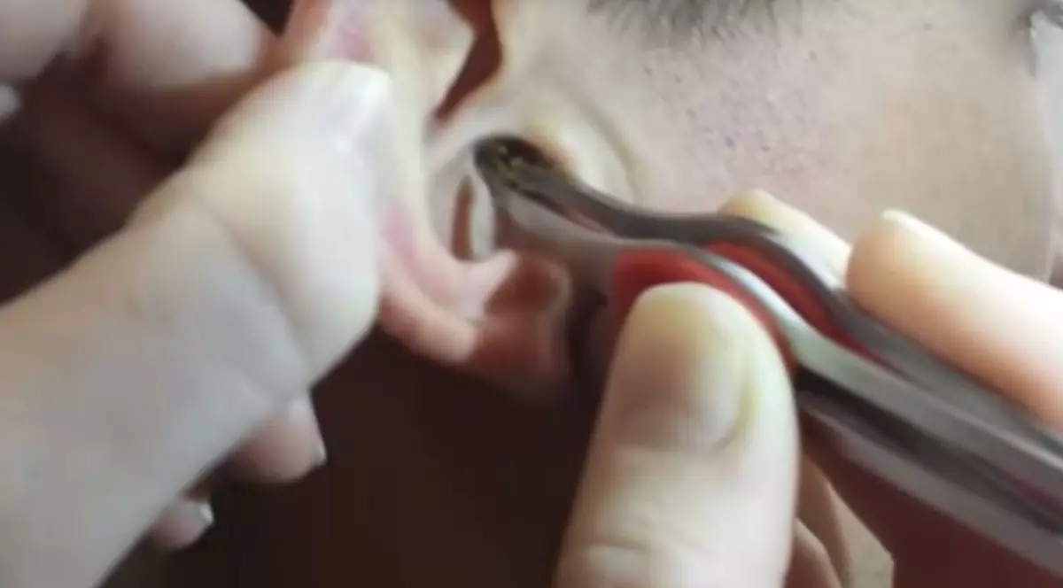 O șopârlă gecko a intrat în urechea internă a unui chinez