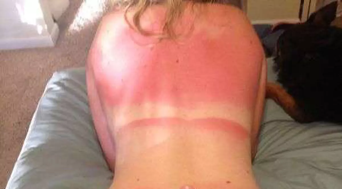 OUCH! Uite cum s-au ars pe plajă acești tineri! GALERIE FOTO 