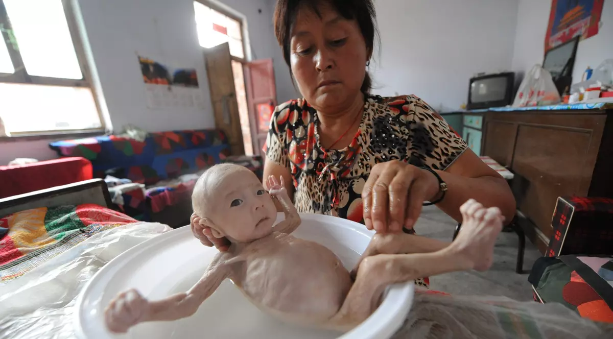 De necrezut! El este copilul născut FĂRĂ ANUS! | FOTO