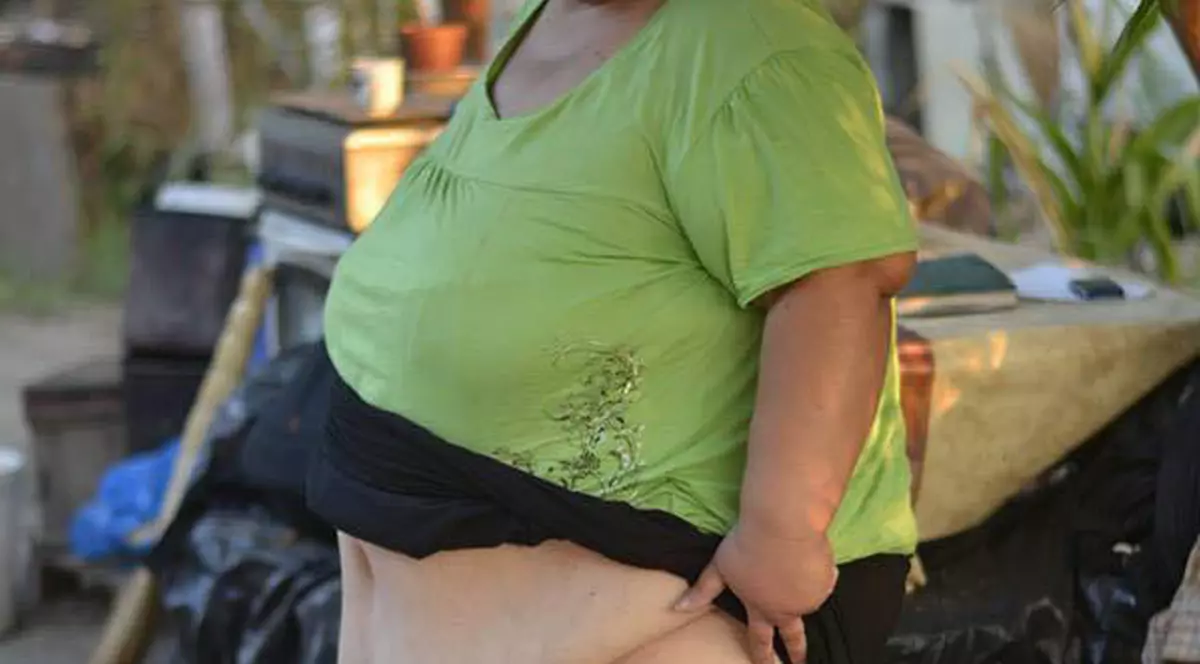 Drama buzoiencei care suferă de "boala picioarelor de elefant". Are 200 de kilograme şi se îngraşă pe zi ce trece 