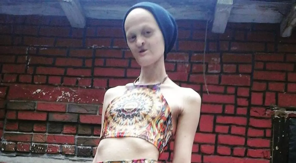 Toată viața lumea a râs de ea pentru că nu are dinți, păr și e parțial oarbă. Acum a ajuns celebră