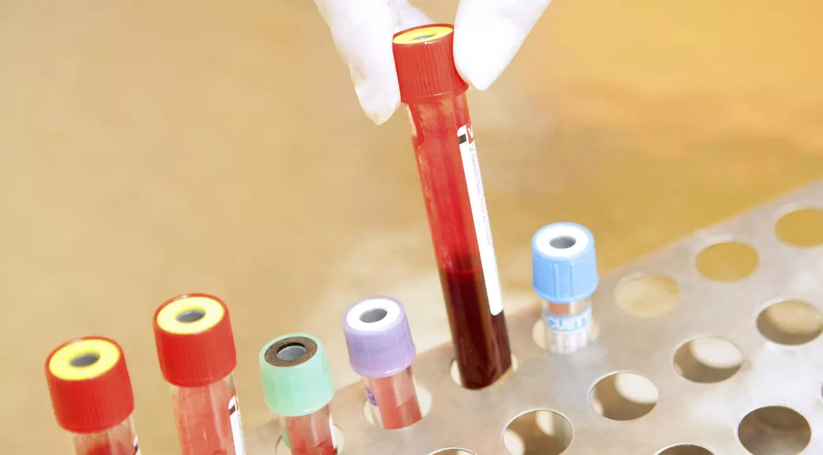 Ce cred tinerii români despre virusul HIV! Tu știi cum se transmite?