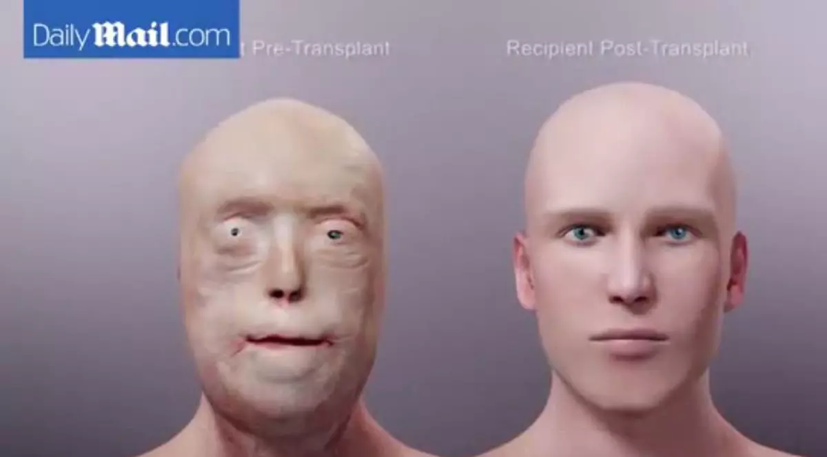 Transplantul total! Un fost pompier american, beneficiarul celui mai extins transplant de faţă din lume | VIDEO