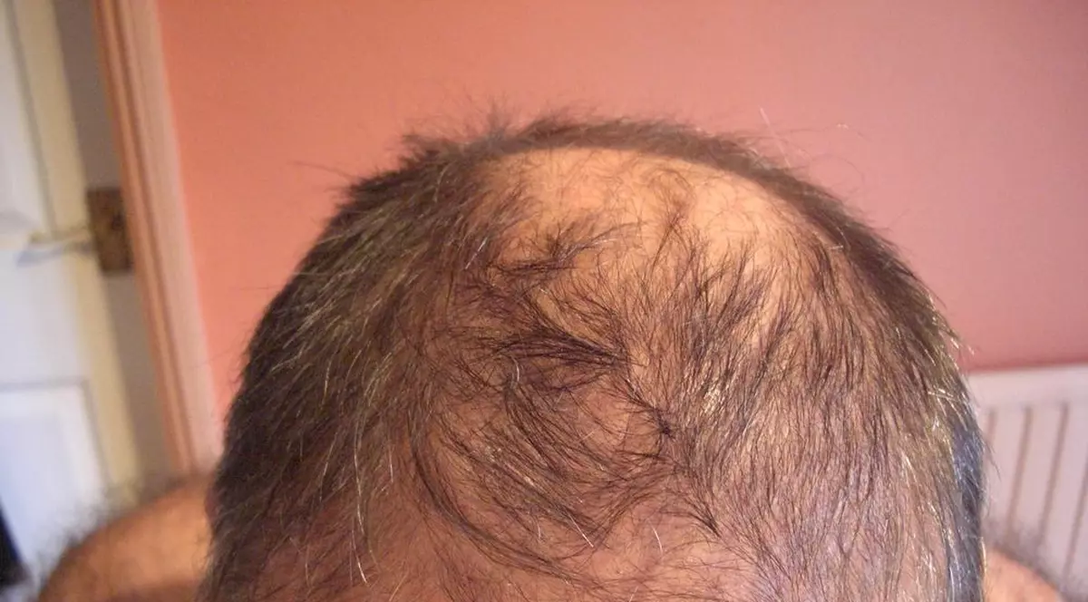 GATA! Cercetătorii au găsit SOLUȚIA ÎMPOTRIVA CĂDERII PĂRULUI