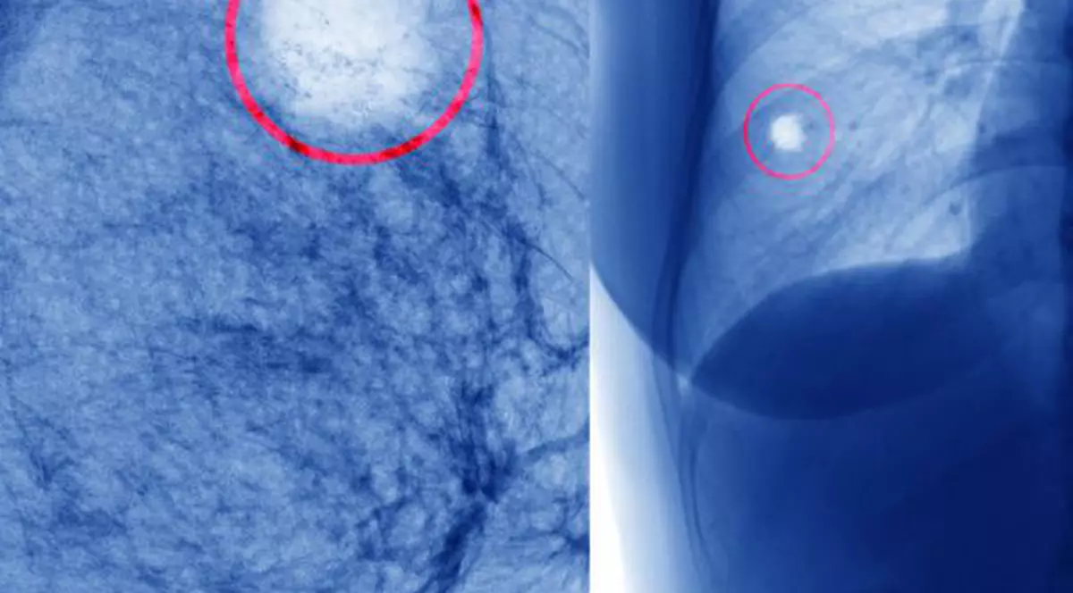 CONCLUZIE dramatică a oamenilor de știință. Ce ne poate îmbolnăvi de CANCER