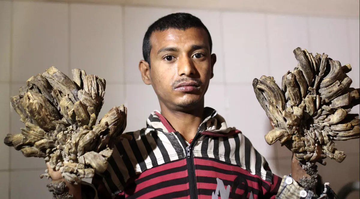 Un tânăr se transformă în COPAC. Suferă de o boală cumplită | FOTO