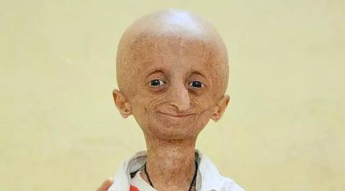 Băieţelul care suferă de "boala lui Benjamin Button" i-a uimit pe medici. Are 15 ani, dar arată de 80