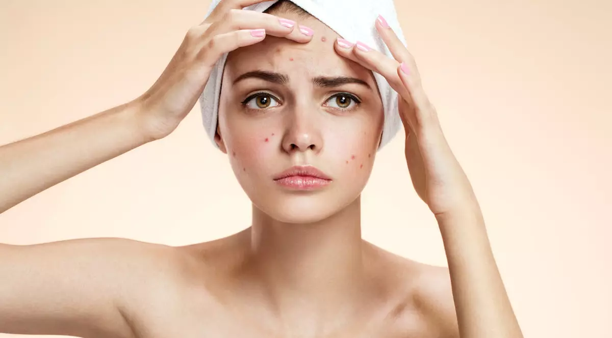 Ce spun coșurile de pe față despre stilul tău de viață!