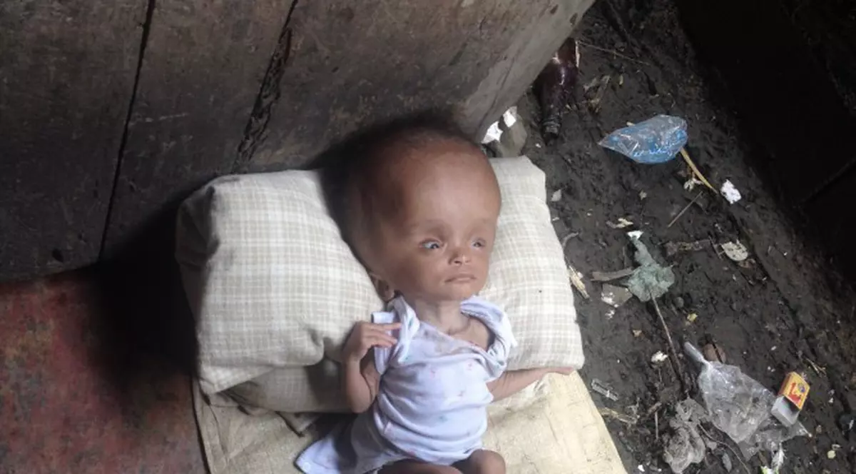 Emoționant! A adoptat o fetiță abandonată, care suferea de hidrocefalie. Cum arată acum copila | Imagini cu puternic impact emoțional