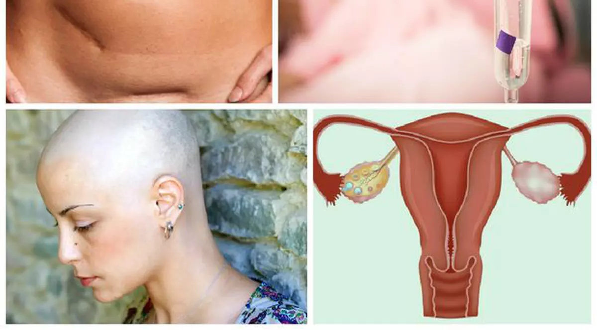 Controlul făcut la timp îți poate salva viața! 1.020 românce pierd anual lupta cu cancerul ovarian