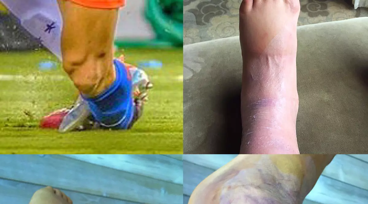 Nu e deloc ușoară viața de fotbalist! Imagini horror cu picioarele unui proaspăt câștigător al Copei America