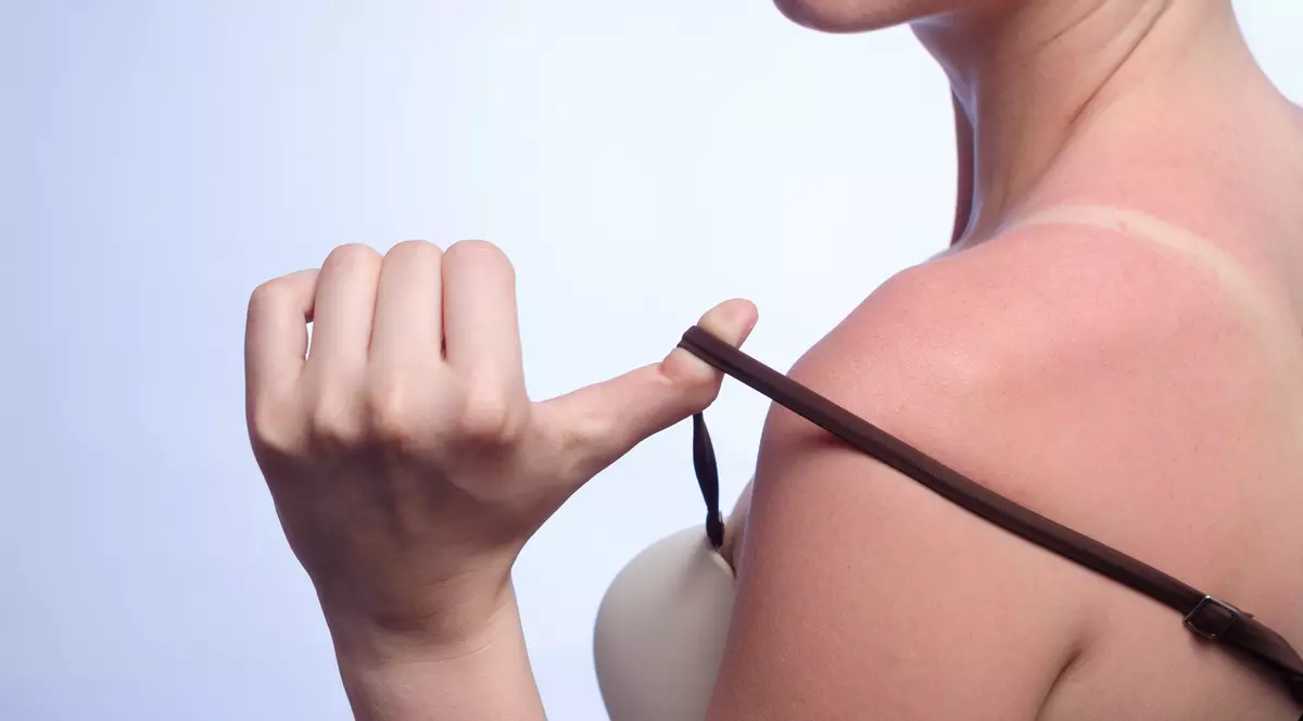 Leacuri din bătrâni pentru pielea arsă de soare. Alină usturimea cu ce ai prin cămară